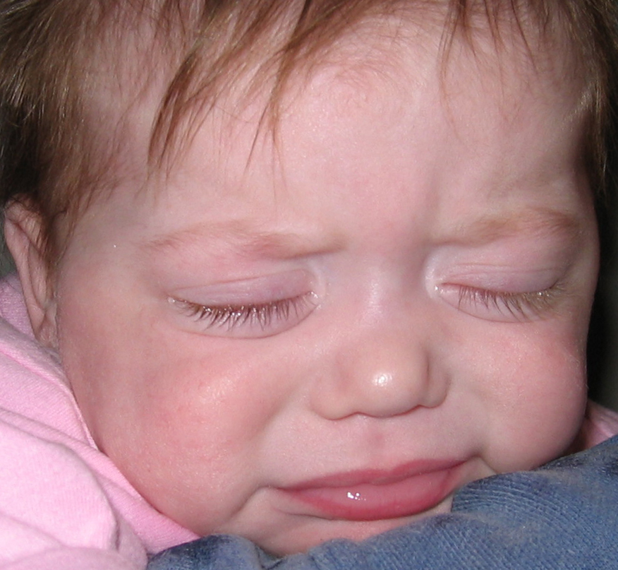 blepharospasm and photophobia